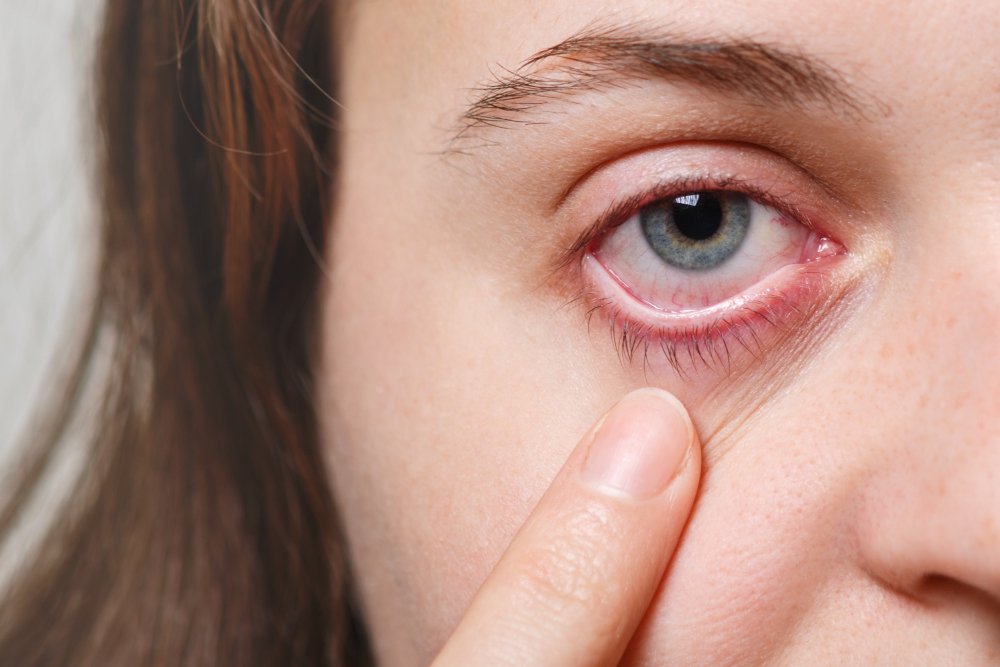 Zapalenie brzegów powiek - czerwone oko