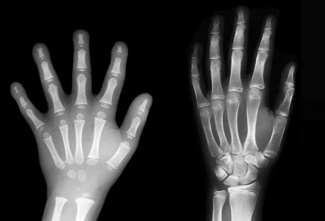 rentgen ręki dziecka w wieku przedszkolnym i szkolnym